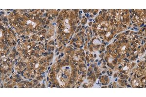 Immunohistochemistry of paraffin-embedded Human thyroid cancer using GALK1 Polyclonal Antibody at dilution of 1:40 (GALK1 antibody)