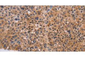 Immunohistochemistry of paraffin-embedded Human liver cancer tissue using NIF3L1 Polyclonal Antibody at dilution 1:30 (NIF3L1 antibody)