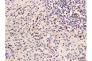 Formalin-fixed and paraffin embedded human cervical carcinoma labeled with Anti-HER2/NEU/ErbB2 Polyclonal Antibody, Unconjugated (ABIN725345) at 1:400 followed by conjugation to the secondary antibody and DAB staining (ErbB2/Her2 antibody  (AA 1210-1255))