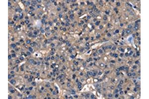 The image on the left is immunohistochemistry of paraffin-embedded Human liver cancer tissue using ABIN7129820(IGFBP5 Antibody) at dilution 1/25, on the right is treated with fusion protein. (IGFBP5 antibody)