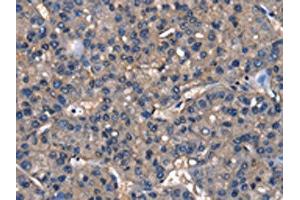 The image on the left is immunohistochemistry of paraffin-embedded Human liver cancer tissue using ABIN7129820(IGFBP5 Antibody) at dilution 1/25, on the right is treated with fusion protein.