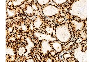 ABIN7094292 and ABIN7098339 at 1/100 staining Human lung cancer by IHC-P.