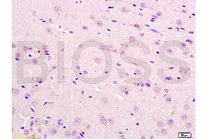 Formalin-fixed and paraffin embedded human bladder carcinoma labeled with Anti-IL12RB2 Polyclonal Antibody, Unconjugated (ABIN747878) at 1:200 followed by conjugation to the secondary antibody and DAB staining (IL12RB2 antibody  (AA 301-400))