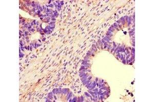 Immunohistochemistry of paraffin-embedded human ovarian cancer using ABIN7161242 at dilution of 1:100
