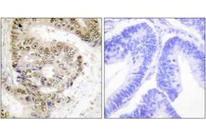 Immunohistochemistry analysis of paraffin-embedded human colon carcinoma tissue, using hnRNP L Antibody. (HNRNPL antibody  (AA 61-110))