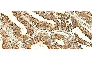 Immunohistochemistry of paraffin-embedded Human colorectal cancer tissue using ATP5PD Polyclonal Antibody at dilution of 1:50(x200) (ATP5H antibody)