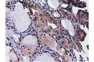 Immunohistochemical staining of paraffin-embedded Adenocarcinoma of Human ovary tissue using anti-CBWD1 mouse monoclonal antibody. (CBWD1 antibody)