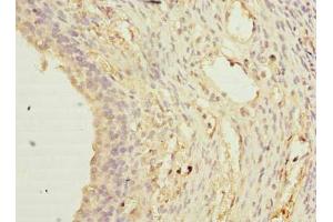 Immunohistochemistry of paraffin-embedded human ovarian cancer using ABIN7171670 at dilution of 1:100 (TCTEX1D2 antibody  (AA 1-142))