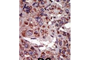 Formalin-fixed and paraffin-embedded human cancer tissue reacted with the primary antibody, which was peroxidase-conjugated to the secondary antibody, followed by AEC staining. (DGKA antibody  (C-Term))