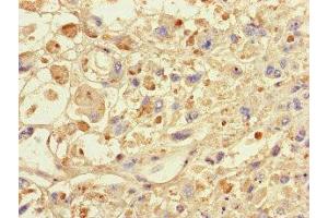 Immunohistochemistry of paraffin-embedded human melanoma using ABIN7146024 at dilution of 1:100 (SPAG9 antibody  (N-Term))