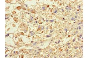 Immunohistochemistry of paraffin-embedded human melanoma using ABIN7146024 at dilution of 1:100 (SPAG9 antibody  (N-Term))