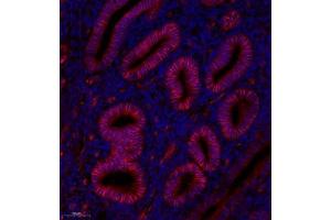 Immunofluorescence analysis of paraffin embedded human endometrial cancer using GDF5 (ABIN7074131) at dilution of 1: 200 (GDF5 antibody)