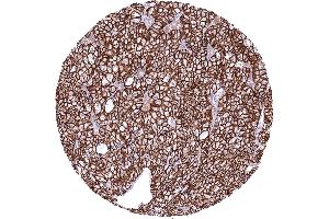 Kidney Chromophobe renal cell carcinoma with strong CDH16 immunostaining of tumor cells CDH16 immunohistochemistry (Recombinant Cadherin-16 antibody)
