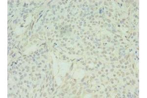 Immunohistochemistry of paraffin-embedded human breast cancer using ABIN7170902 at dilution of 1:100 (SDHC antibody  (AA 30-62))