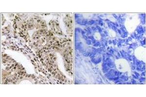 Immunohistochemistry analysis of paraffin-embedded human lung carcinoma, using AS160 (Phospho-Thr642) Antibody. (TBC1D4 antibody  (pThr642))