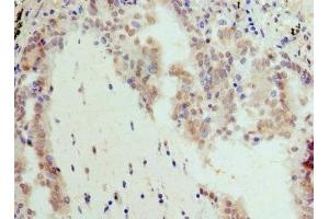 Immunohistochemistry of paraffin-embedded human lung cancer using ABIN7145816 at dilution of 1:100 (BRD7 antibody  (AA 601-651))