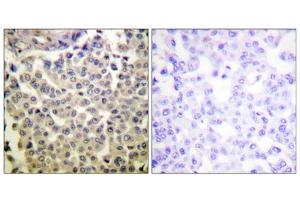 Immunohistochemistry analysis of paraffin-embedded human breast carcinoma tissue using PAK1/2/3 (Phospho-Thr423/402/421) antibody.