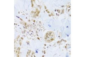 Immunohistochemistry of paraffin-embedded human breast cancer using MCM4 Antibody (ABIN5971548) at dilution of 1/100 (40x lens). (MCM4 antibody)