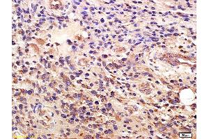 Formalin-fixed and paraffin embedded human glioma labeled with Anti-GLI1/ZFP5 Polyclonal Antibody, Unconjugated (ABIN673374) at 1:200 followed by conjugation to the secondary antibody and DAB staining. (GLI1 antibody  (AA 601-700))