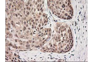 Immunohistochemical staining of paraffin-embedded Adenocarcinoma of Human breast tissue using anti-MGLL mouse monoclonal antibody. (MGLL antibody)