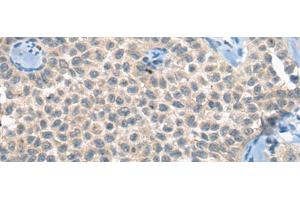 Immunohistochemistry of paraffin-embedded Human ovarian cancer tissue using CLTCL1 Polyclonal Antibody at dilution of 1:60(x200)