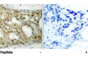 Immunohistochemical analysis of paraffin-embedded human breast carcinoma tissue using BCL2 polyclonal antibody . (Bcl-2 antibody)