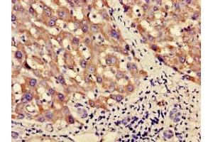 Immunohistochemistry of paraffin-embedded human liver cancer using ABIN7162571 at dilution of 1:100 (PNLIPRP3 antibody  (AA 201-467))