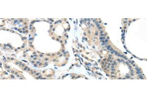 Immunohistochemistry of paraffin-embedded Human thyroid cancer tissue using VSIG10 Polyclonal Antibody at dilution 1:45