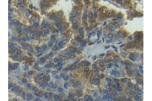 Detection of MMP7 in Human Thyroid cancer Tissue using Polyclonal Antibody to Matrix Metalloproteinase 7 (MMP7)