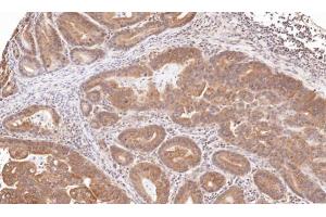 IHC-P Image Immunohistochemical analysis of paraffin-embedded human gastric cancer, using TRIM23, antibody at 1:100 dilution. (TRIM23 antibody  (N-Term))
