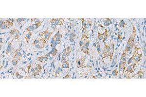 Immunohistochemistry of paraffin-embedded Human liver cancer tissue using PLA2G15 Polyclonal Antibody at dilution of 1:65(x200) (PLA2G15 antibody)