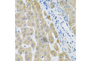 Immunohistochemistry of paraffin-embedded human liver cancer using ALG2 Antibody. (ALG2 antibody)