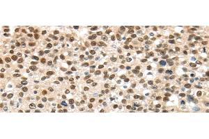 Immunohistochemistry of paraffin-embedded Human breast cancer using UBA1 Polyclonal Antibody at dilution of 1/40 (UBA1 antibody)
