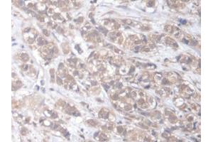 DAB staining on IHC-P; Samples: Human Breast cancer Tissue (ELMO2 antibody  (AA 501-720))
