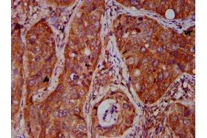 IHC image of ABIN7165140 diluted at 1:500 and staining in paraffin-embedded human cervical cancer performed on a Leica BondTM system. (BICD2 antibody  (AA 511-625))