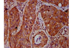 IHC image of ABIN7165140 diluted at 1:500 and staining in paraffin-embedded human cervical cancer performed on a Leica BondTM system.