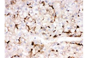 APOA1 was detected in paraffin-embedded sections of human liver cancer tissues using rabbit anti- APOA1 Antigen Affinity purified polyclonal antibody (Catalog # ) at 1 µg/mL. (APOA1 antibody  (AA 25-267))