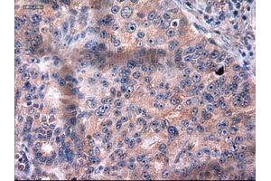 Immunohistochemical staining of paraffin-embedded Carcinoma of kidney using anti-KRT18 (ABIN2452674) mouse monoclonal antibody. (Cytokeratin 18 antibody  (AA 69-372))