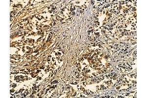 ABIN7094909 and ABIN7098963 at 1/100 staining human pancreatic cancer by IHC-P. (IL23 antibody)