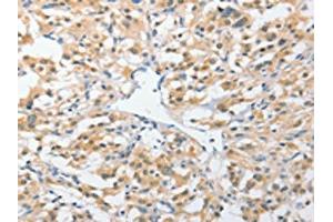 The image on the left is immunohistochemistry of paraffin-embedded Human thyroid cancer tissue using ABIN7131538(UCHL5 Antibody) at dilution 1/25, on the right is treated with fusion protein. (UCHL5 antibody)