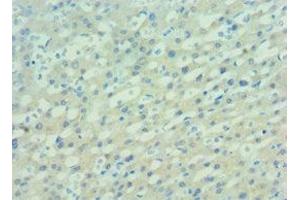 Immunohistochemistry of paraffin-embedded human lung cancer using ABIN7162506 at dilution of 1:100 (PAX7 antibody  (AA 291-520))