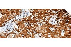Immunohistochemistry of paraffin-embedded Human cervical cancer tissue using FGD3 Polyclonal Antibody at dilution of 1:50(x200) (FGD3 antibody)