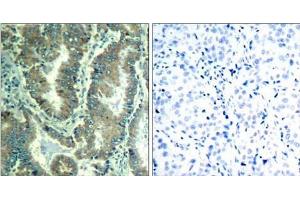 Immunohistochemical analysis of paraffin-embedded human lung carcinoma tissue using α -catenin (Ab-177) Antibody (E021521). (CTNNA1 antibody)