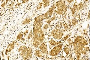Immunohistochemical analysis of paraffin-embedded Human Breast cancer section using Pink1 (ABIN1944789 and ABIN2838529). (STAT3 antibody)