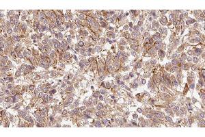 ABIN6278955 at 1/100 staining Human Melanoma tissue by IHC-P. (WNT6 antibody  (Internal Region))