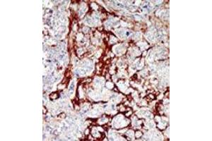 Formalin-fixed and paraffin-embedded human cancer tissue reacted with the primary antibody, which was peroxidase-conjugated to the secondary antibody, followed by DAB staining. (CDKL1 antibody  (C-Term))