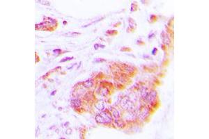 Immunohistochemical analysis of COX17 staining in human lung cancer formalin fixed paraffin embedded tissue section. (COX17 antibody  (N-Term))