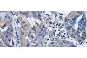 Immunohistochemistry of paraffin-embedded Human breast cancer tissue using PLK4 Polyclonal Antibody at dilution of 1:50(x200) (PLK4 antibody)
