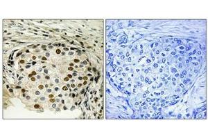 Immunohistochemical analysis of paraffin-embedded human breast carcinoma tissue using OSR1 (Phospho-Thr185) antibody (left)or the same antibody preincubated with blocking peptide (right). (OXSR1 antibody  (pThr185))