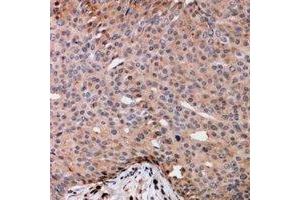 Immunohistochemical analysis of TRAK2 staining in human breast cancer formalin fixed paraffin embedded tissue section. (TRAK2 antibody)